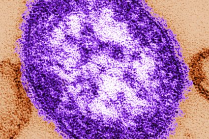 Measles exposure alert issued for communities south of Winnipeg